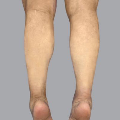 Lipedema Before & After Gallery - Patient 257108 - Image 4