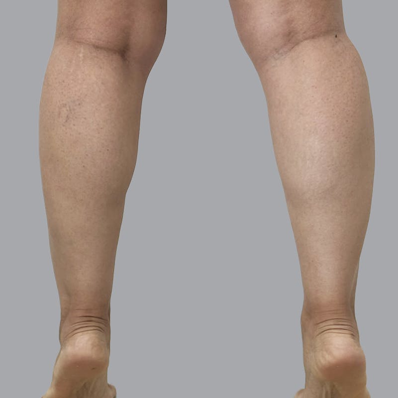 Leg Liposuction Before & After Gallery - Patient 361124 - Image 3