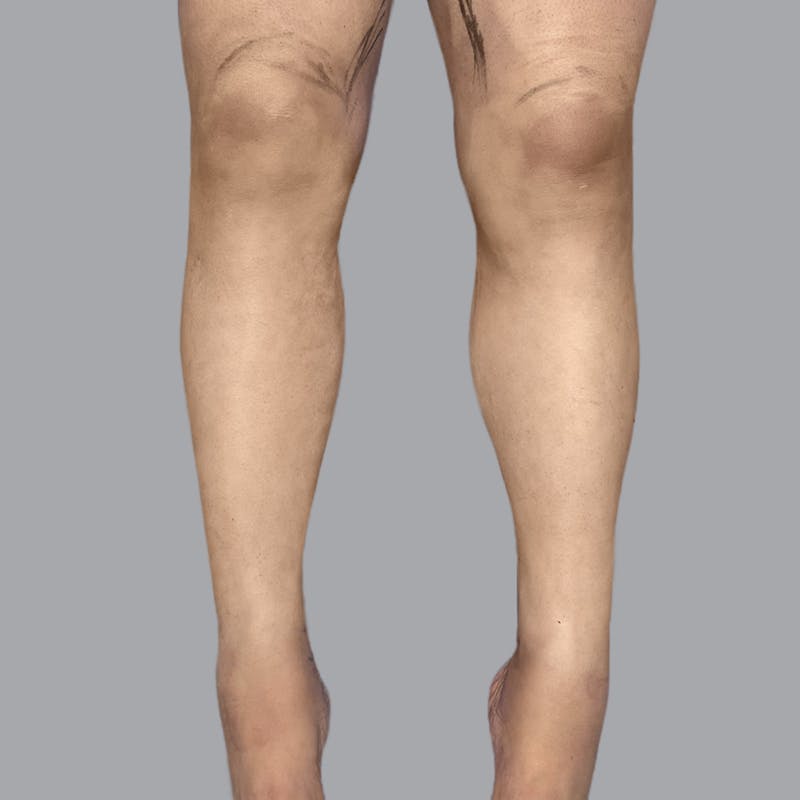 Leg Liposuction Before & After Gallery - Patient 361124 - Image 2
