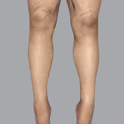 Lipedema Before & After Gallery - Patient 257108 - Image 2