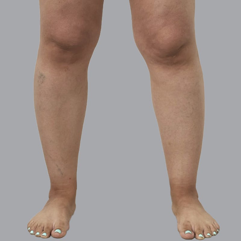 Leg Liposuction Before & After Gallery - Patient 361124 - Image 1