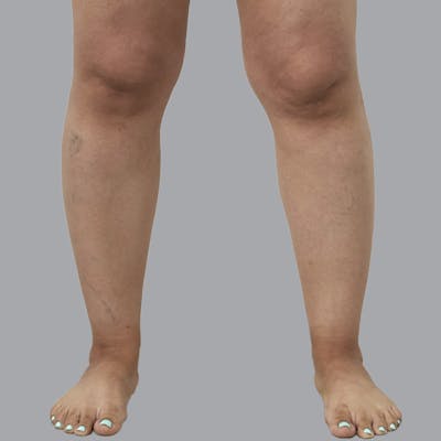 Lipedema Before & After Gallery - Patient 257108 - Image 1