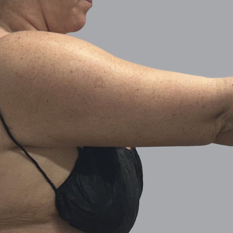 Arm Liposuction Before & After Gallery - Patient 252741 - Image 4