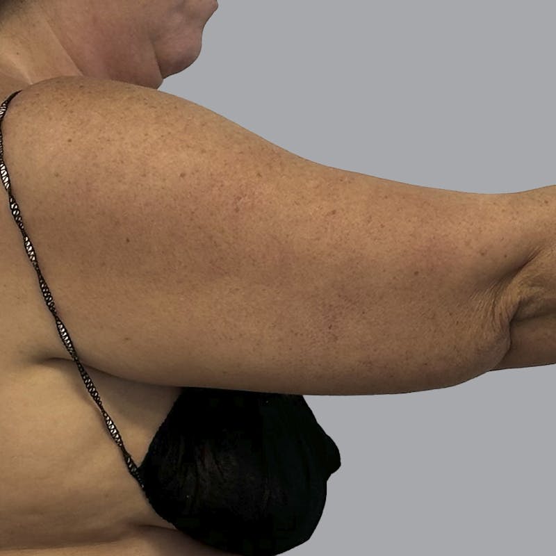 Arm Liposuction Before & After Gallery - Patient 252741 - Image 3