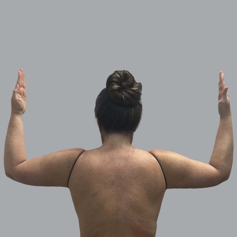 Arm Liposuction Before & After Gallery - Patient 252741 - Image 2