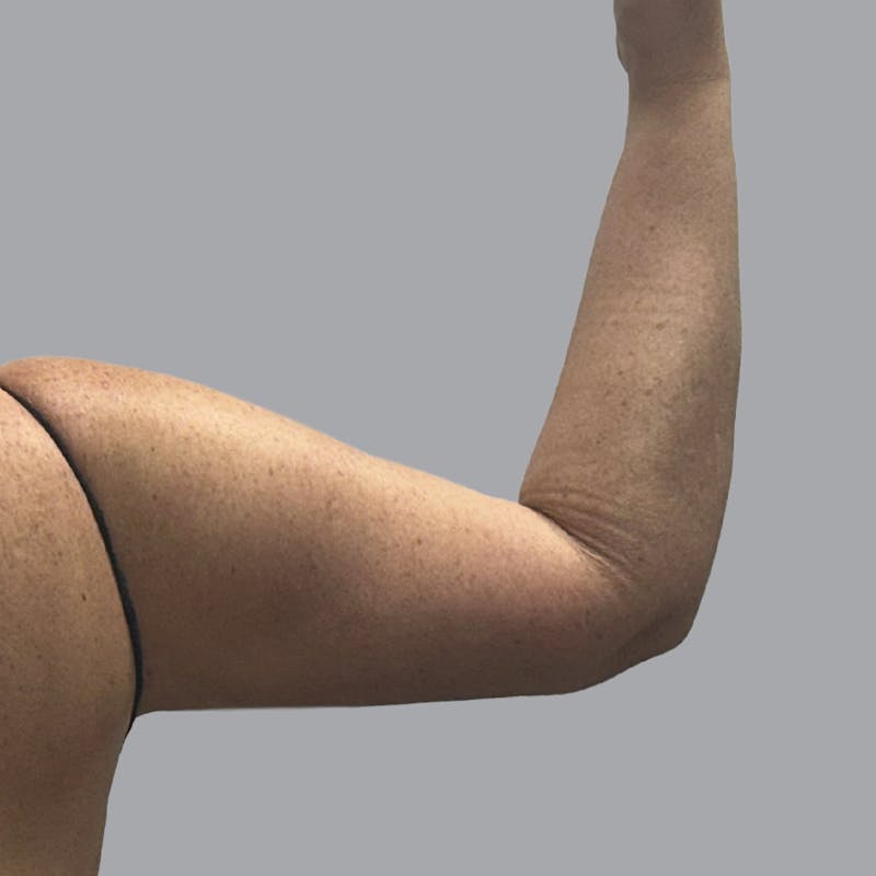 Arm Liposuction Before & After Gallery - Patient 252741 - Image 6