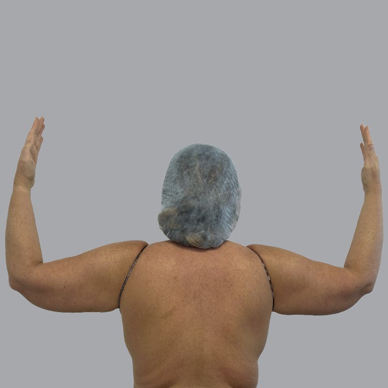 Arm Liposuction Before & After Gallery - Patient 252741 - Image 1
