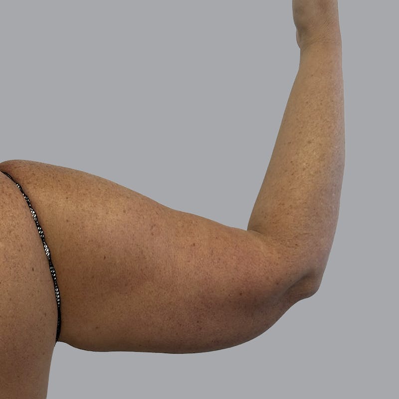 Arm Liposuction Before & After Gallery - Patient 252741 - Image 5