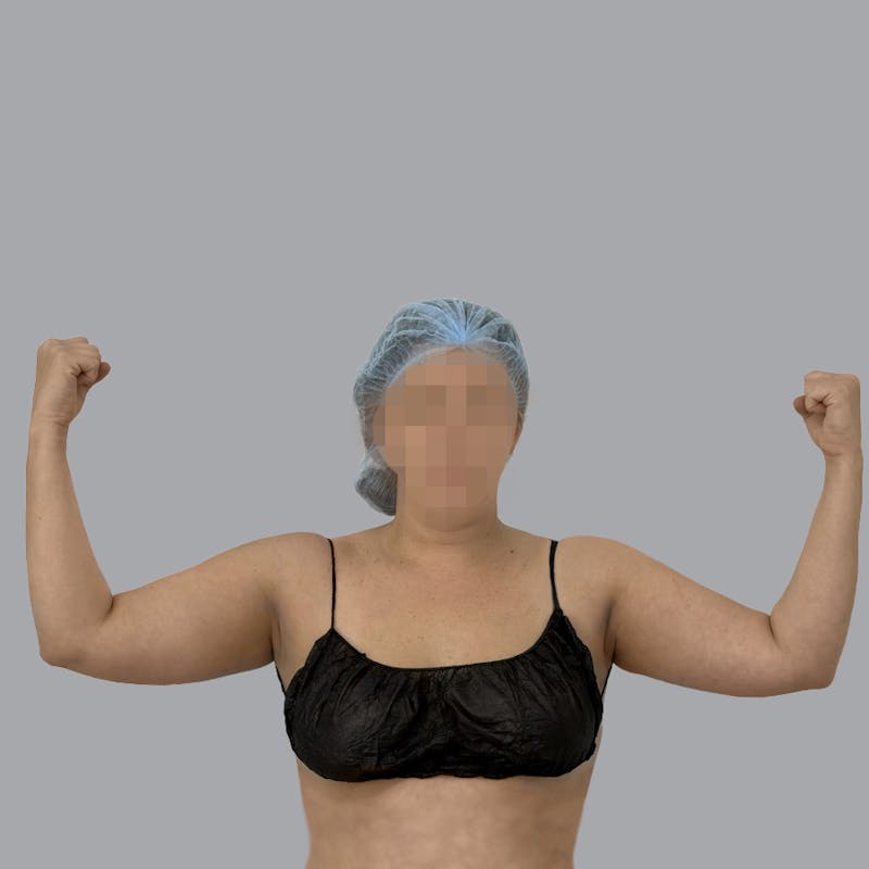 Arm Liposuction Before & After Gallery - Patient 463616 - Image 1