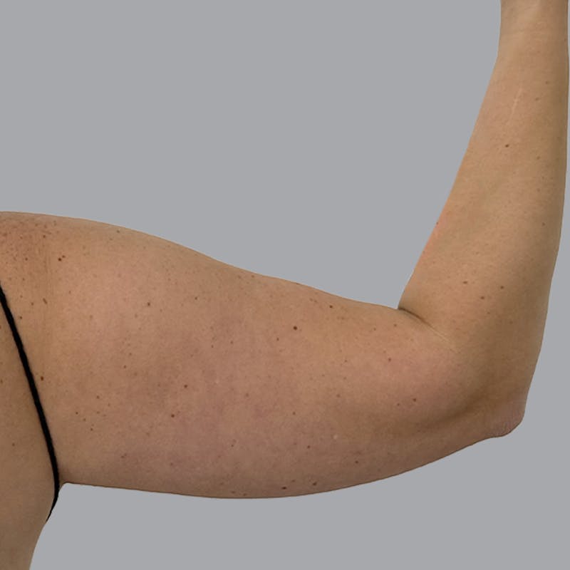Arm Liposuction Before & After Gallery - Patient 463616 - Image 3