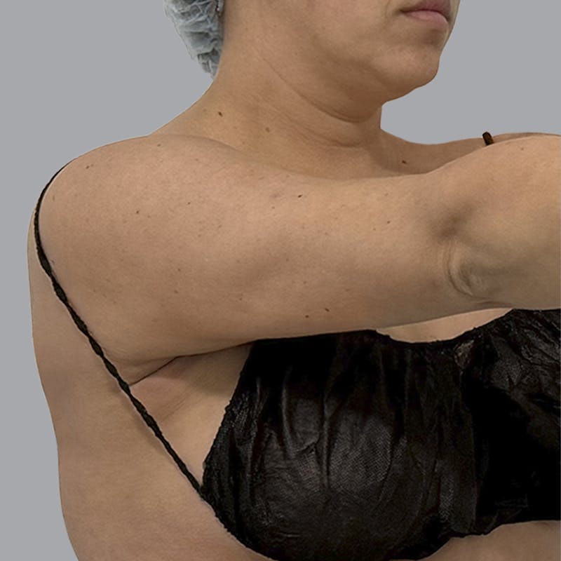 Arm Liposuction Before & After Gallery - Patient 463616 - Image 6