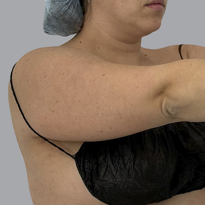 Arm Liposuction Before & After Gallery - Patient 463616 - Image 5