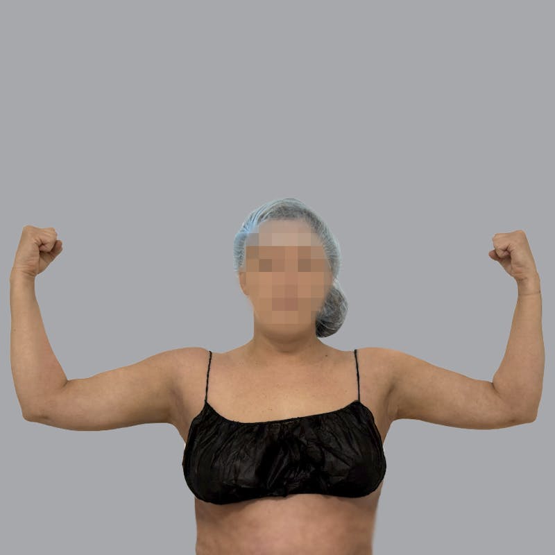 Arm Liposuction Before & After Gallery - Patient 463616 - Image 2