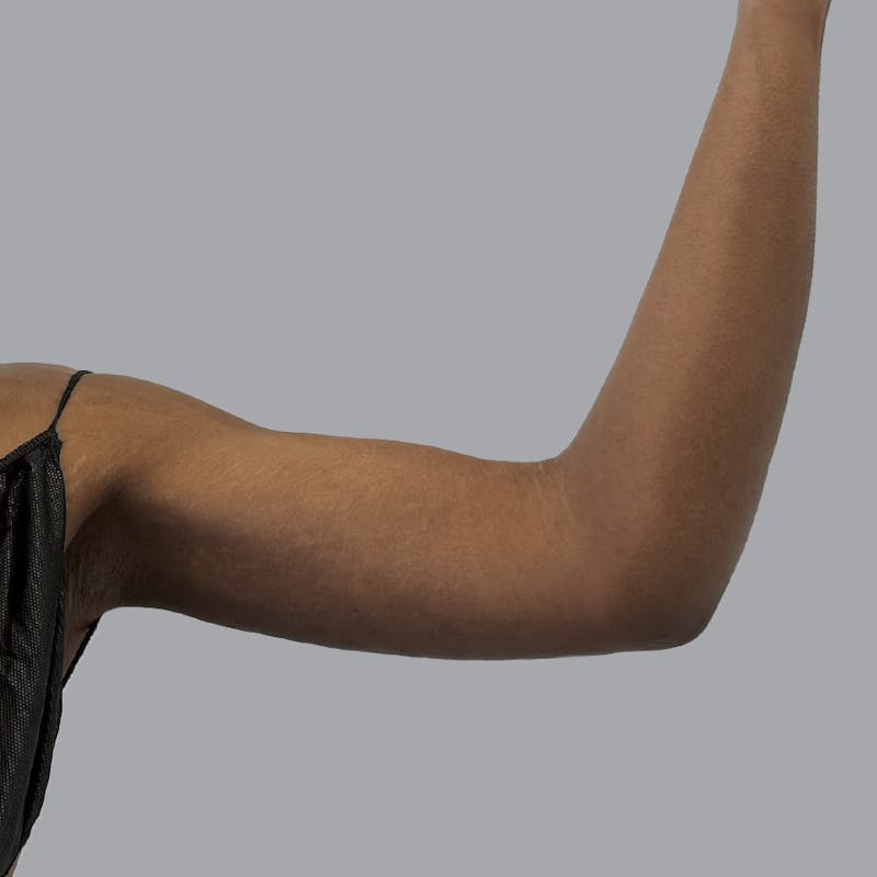Arm Lift Before & After Gallery - Patient 304929 - Image 4
