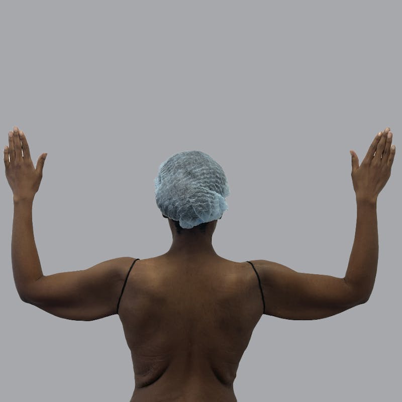 Arm Lift Before & After Gallery - Patient 304929 - Image 1