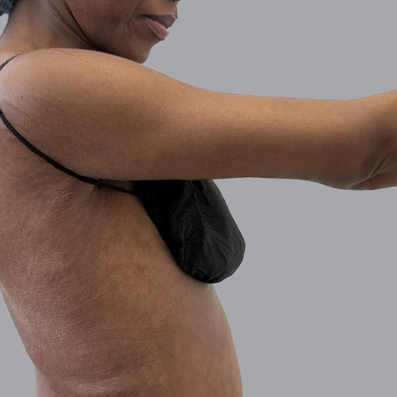 Arm Lift Before & After Gallery - Patient 304929 - Image 6