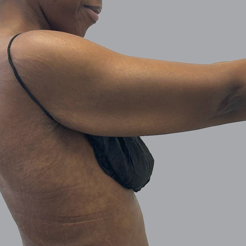 Arm Lift Before & After Gallery - Patient 304929 - Image 5