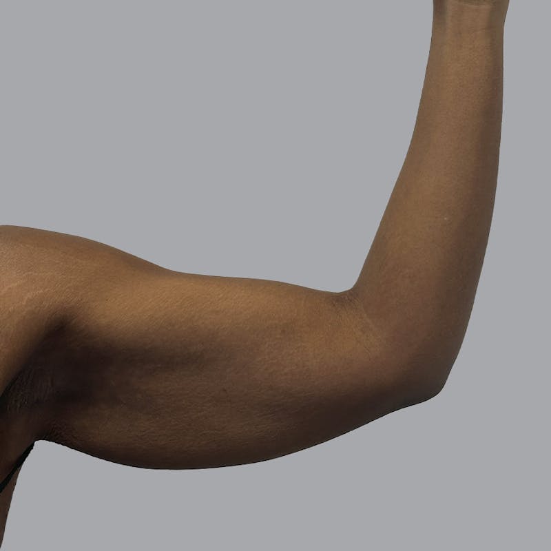 Arm Lift Before & After Gallery - Patient 304929 - Image 3