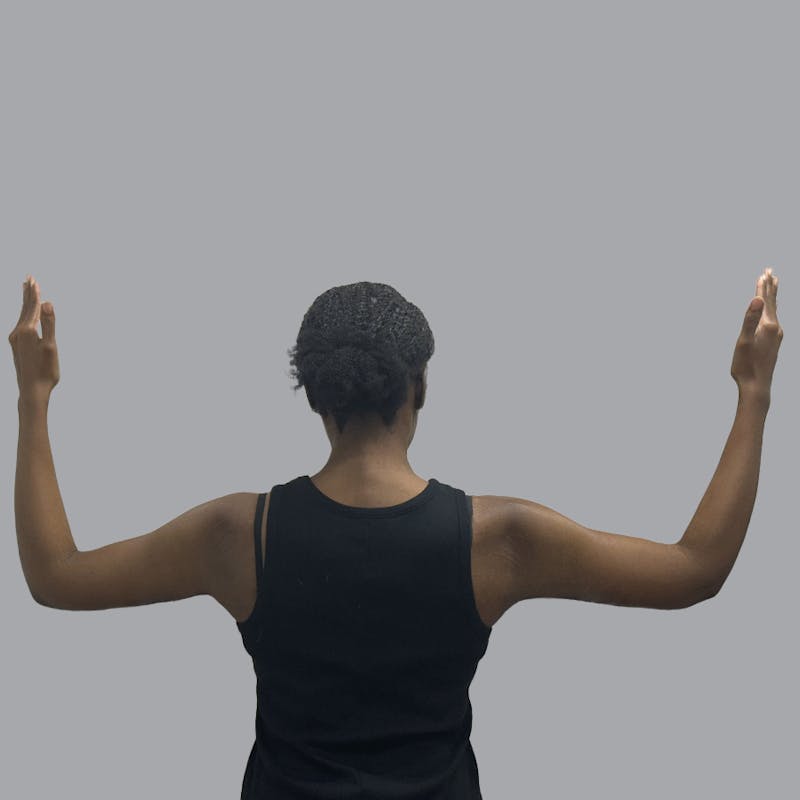Arm Lift Before & After Gallery - Patient 304929 - Image 2