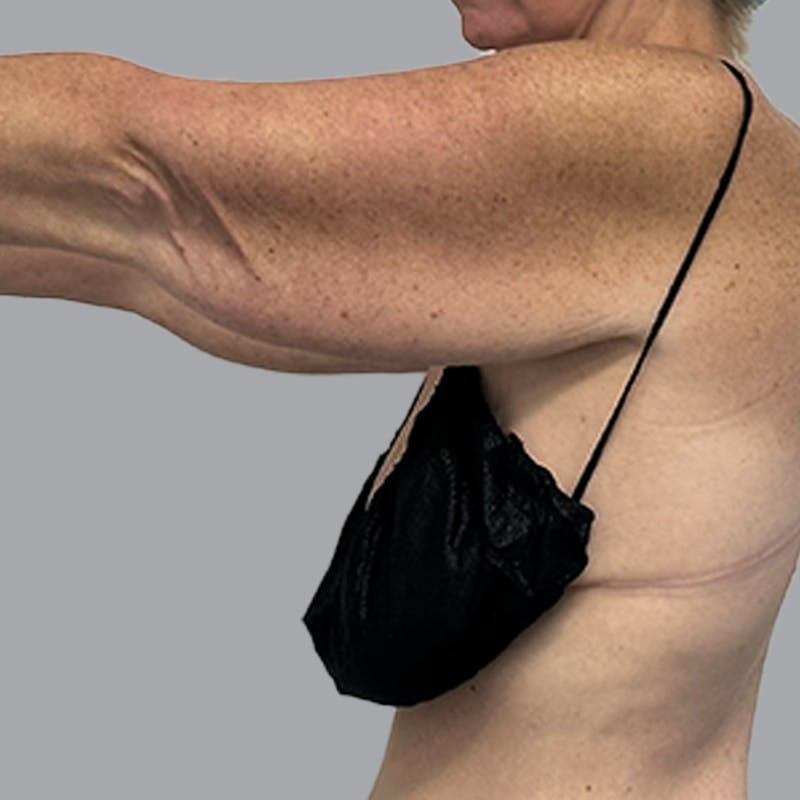 Arm Lift Before & After Gallery - Patient 250597 - Image 5