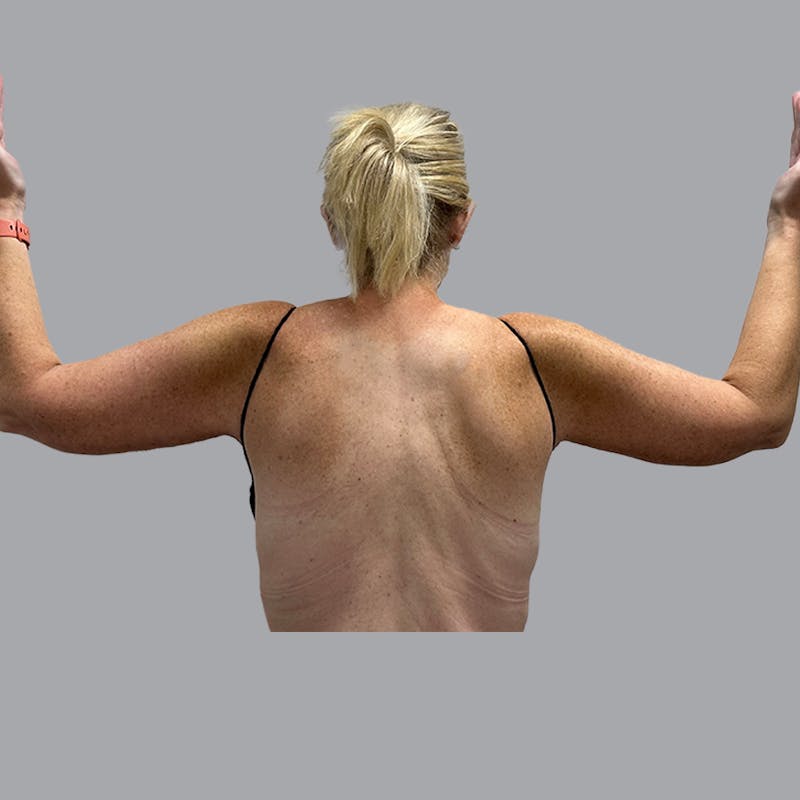 Arm Lift Before & After Gallery - Patient 250597 - Image 2