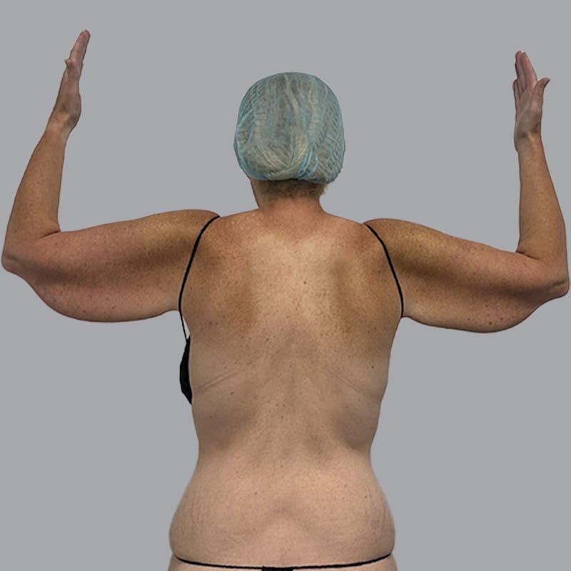 Arm Lift Before & After Gallery - Patient 250597 - Image 1
