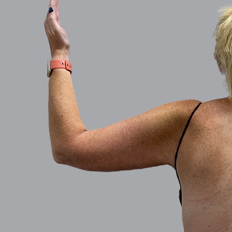 Arm Lift Before & After Gallery - Patient 250597 - Image 4