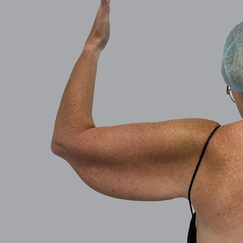 Arm Lift Before & After Gallery - Patient 250597 - Image 3