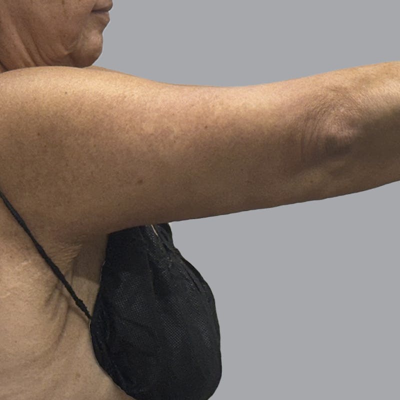 Arm Lift Before & After Gallery - Patient 110154 - Image 8