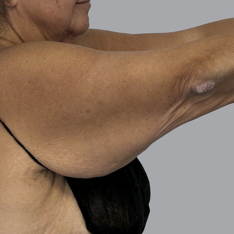Arm Lift Before & After Gallery - Patient 110154 - Image 7