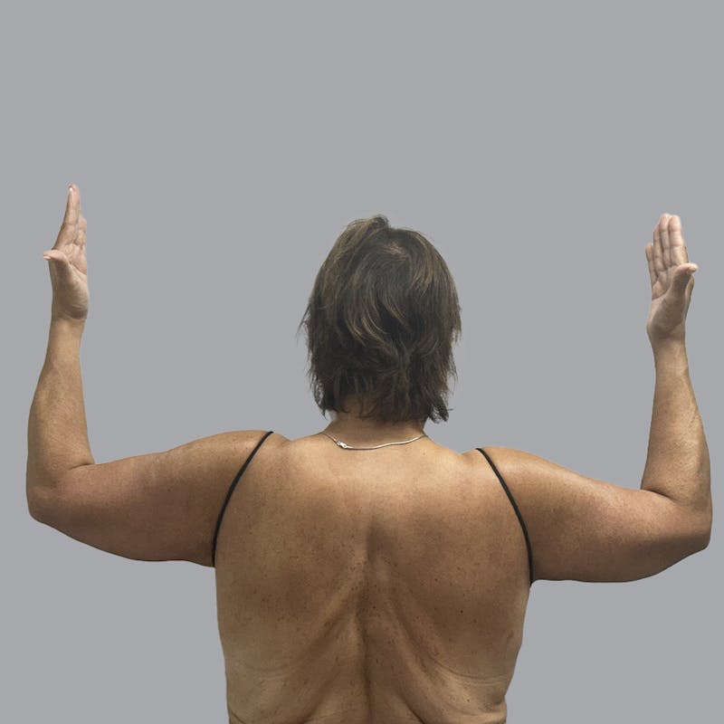Arm Lift Before & After Gallery - Patient 110154 - Image 2
