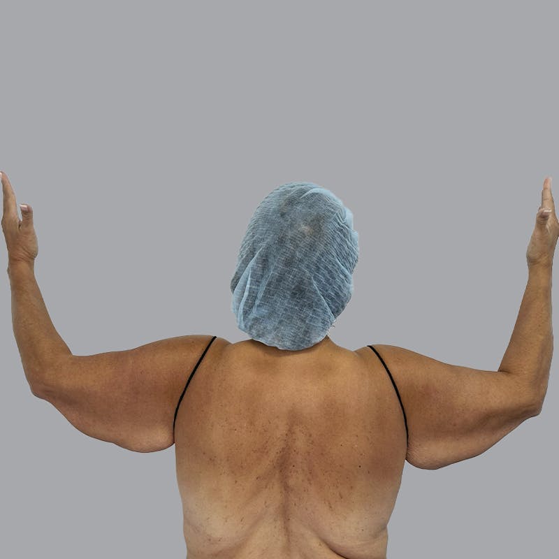 Arm Lift Before & After Gallery - Patient 110154 - Image 1