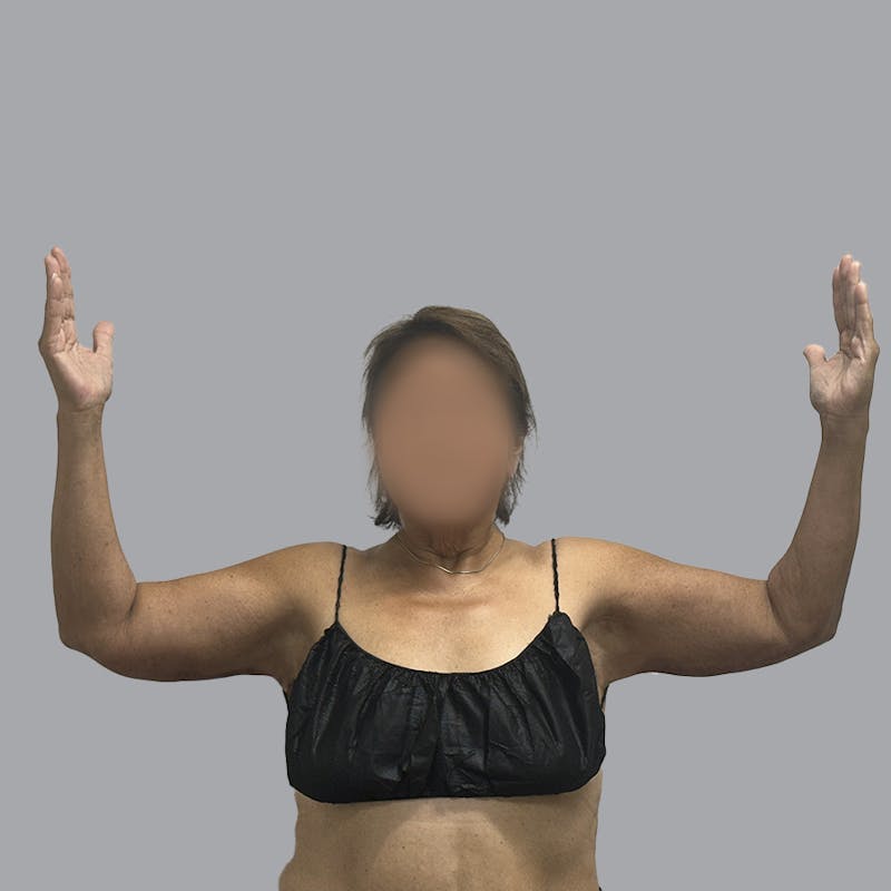 Arm Lift Before & After Gallery - Patient 110154 - Image 4