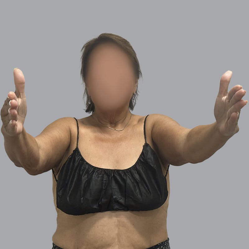 Arm Lift Before & After Gallery - Patient 110154 - Image 6