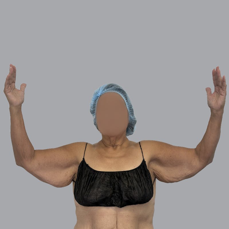Arm Lift Before & After Gallery - Patient 110154 - Image 3