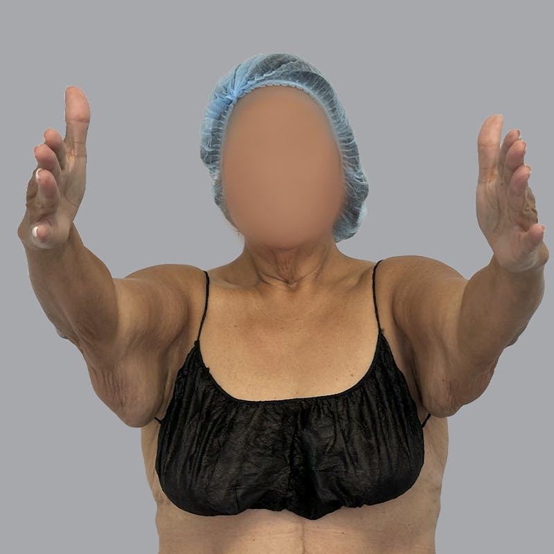 Arm Lift Before & After Gallery - Patient 110154 - Image 5