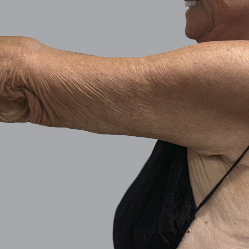 Arm Lift Before & After Gallery - Patient 202555 - Image 6