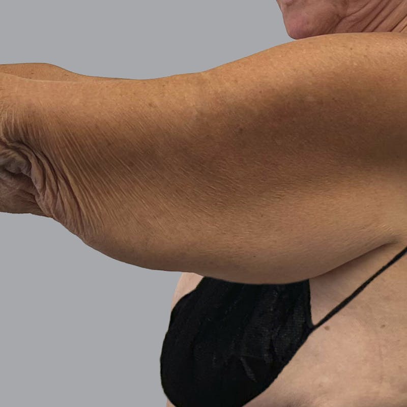 Arm Lift Before & After Gallery - Patient 202555 - Image 5