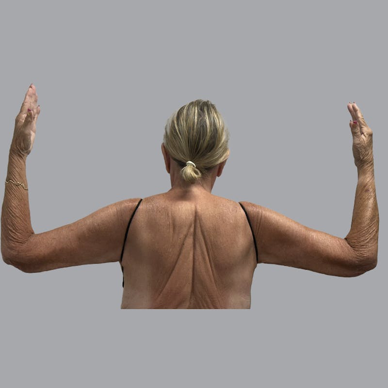 Arm Lift Before & After Gallery - Patient 202555 - Image 2