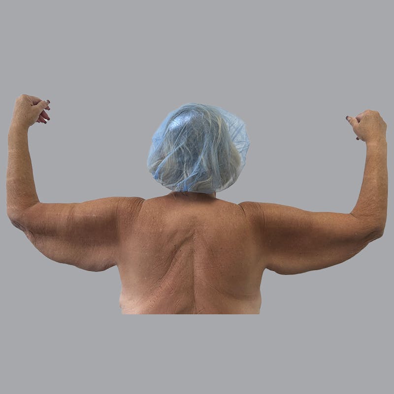 Arm Lift Before & After Gallery - Patient 202555 - Image 1