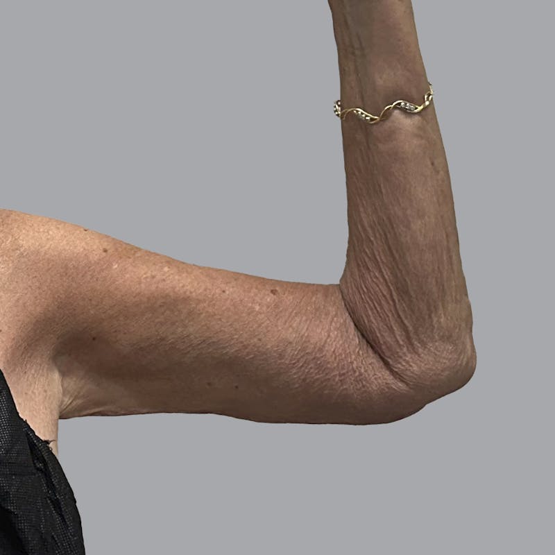 Arm Lift Before & After Gallery - Patient 202555 - Image 4