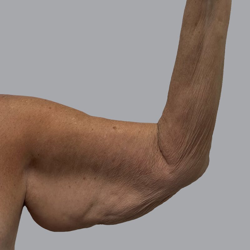 Arm Lift Before & After Gallery - Patient 202555 - Image 3