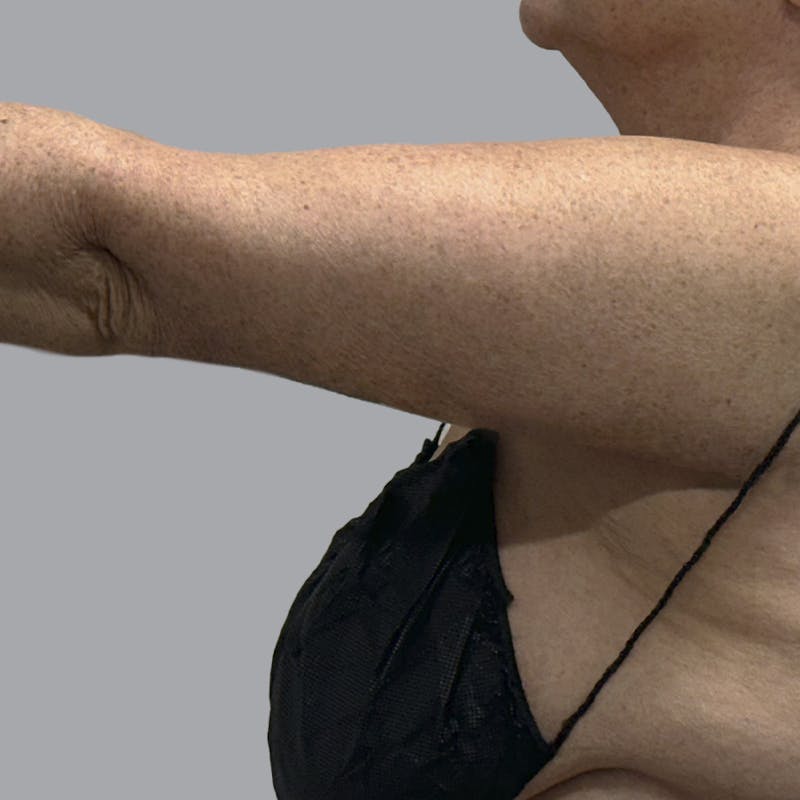 Arm Lift Before & After Gallery - Patient 573659 - Image 6