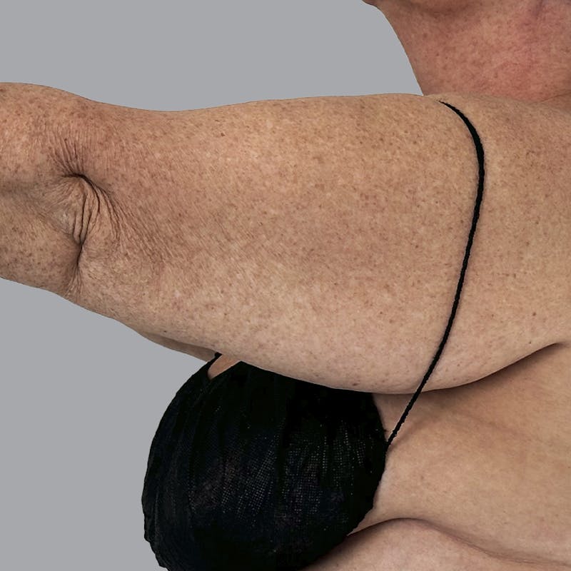 Arm Lift Before & After Gallery - Patient 573659 - Image 5