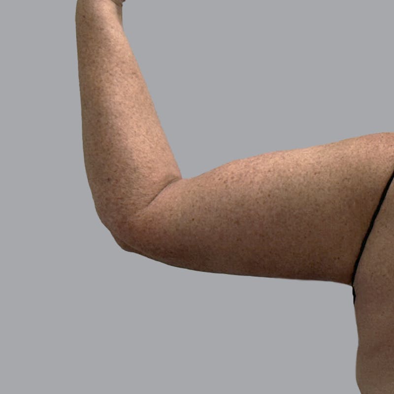 Arm Lift Before & After Gallery - Patient 573659 - Image 2