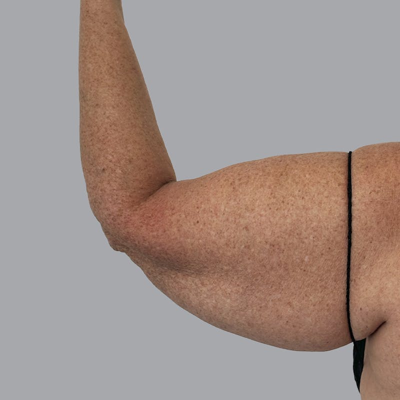 Arm Lift Before & After Gallery - Patient 573659 - Image 1