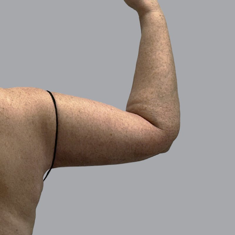 Arm Lift Before & After Gallery - Patient 573659 - Image 4