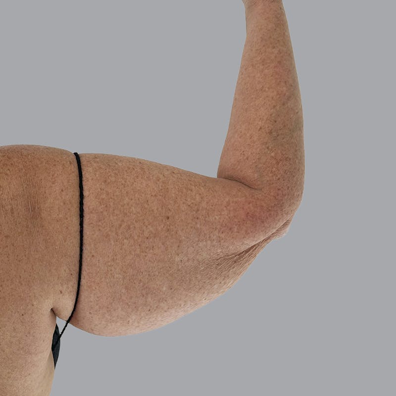 Arm Lift Before & After Gallery - Patient 573659 - Image 3