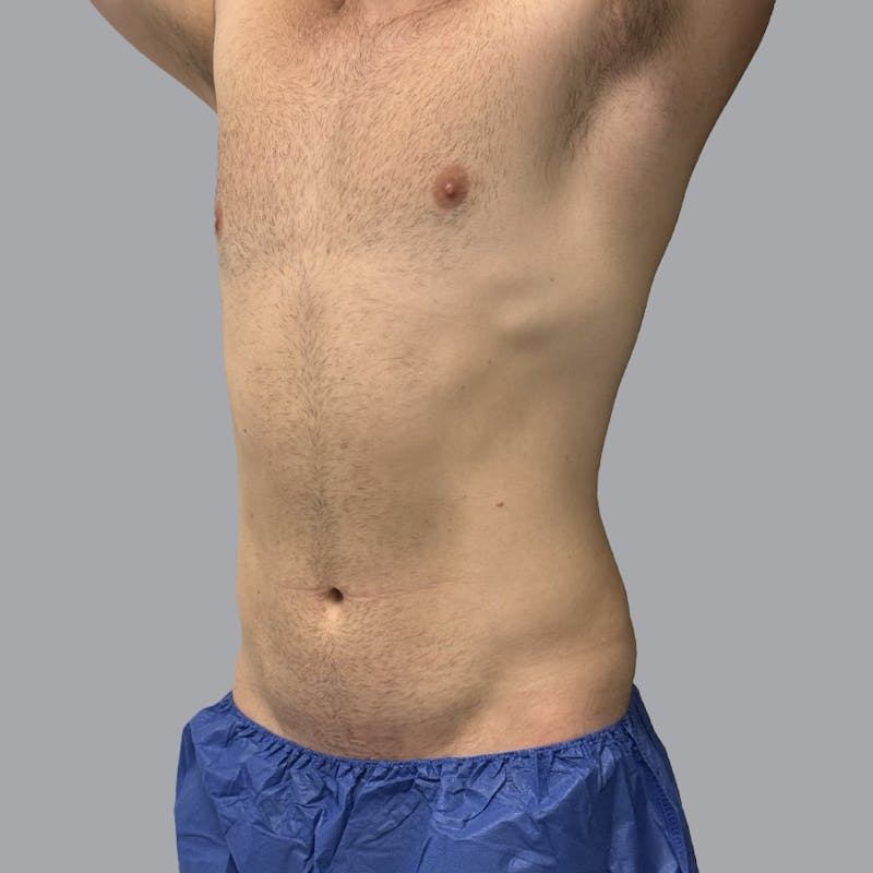 Body Liposuction Before & After Gallery - Patient 146369 - Image 6