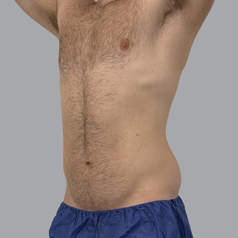Body Liposuction Before & After Gallery - Patient 146369 - Image 5